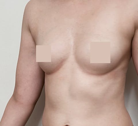 Avant augmentation mammaire