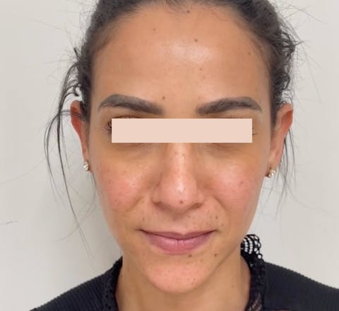 Après Injections de toxine botulique