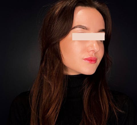 Après Injections d’acide hyaluronique dans les lèvres