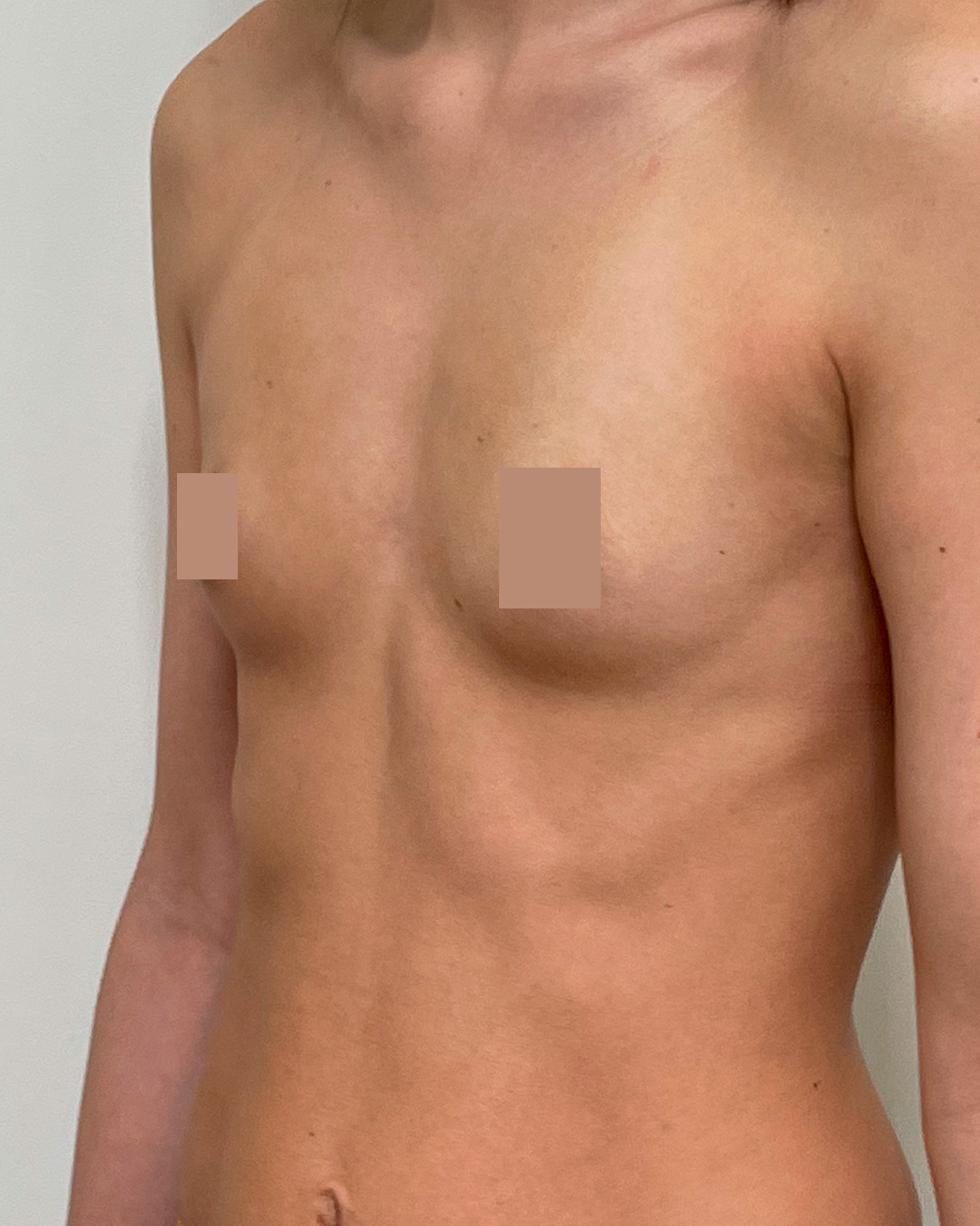 L’augmentation mammaire par prothèses avant