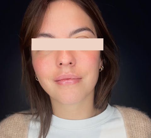 Après Injections d’acide hyaluronique dans les lèvres