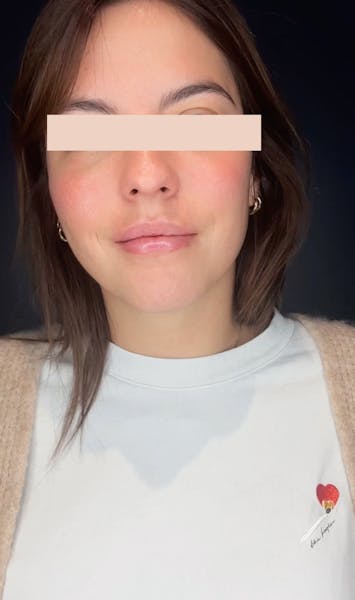 Injections d'acide hyaluronique après