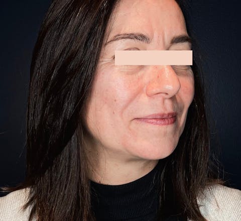 Injections d'acide hyaluronique avant