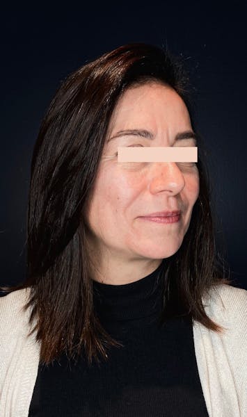 Injections d'acide hyaluronique avant