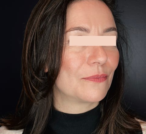 Après injections d'acide hyaluronique par le Dr. Alexandre Mertens