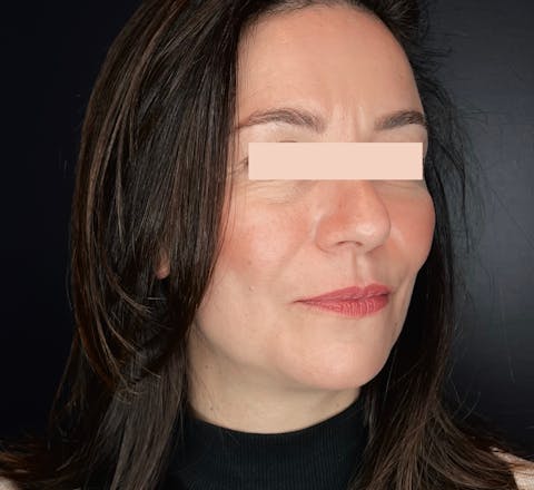 Après injections d'acide hyaluronique