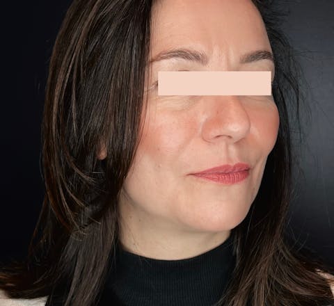 Injections d'acide hyaluronique après