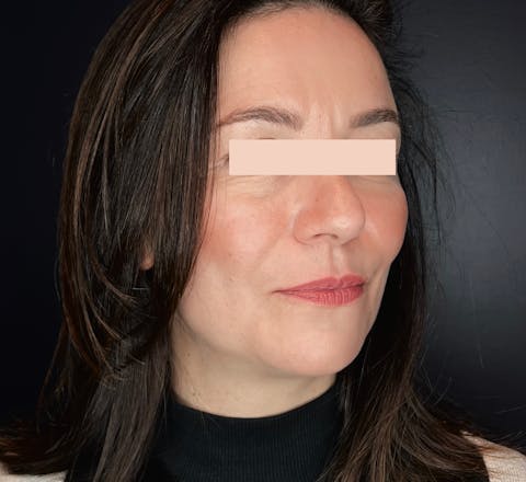 Après Lifting médical par acide hyaluronique