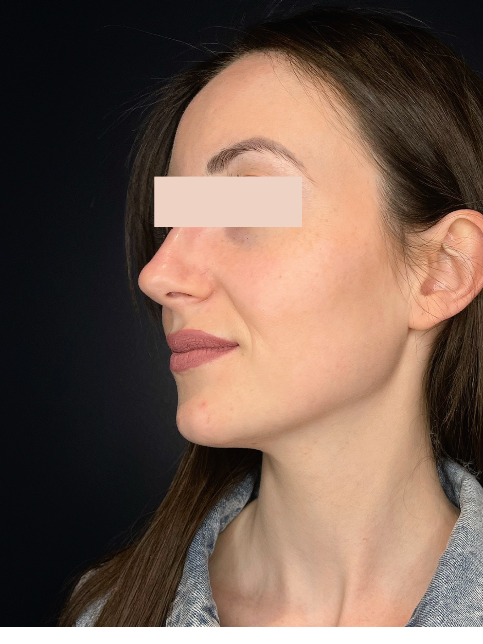 Après Rhinoplastie médicale