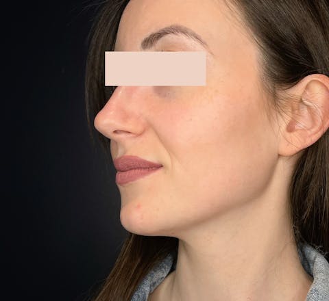 Après rhinoplastie médicale par le Dr. Alexandre Mertens