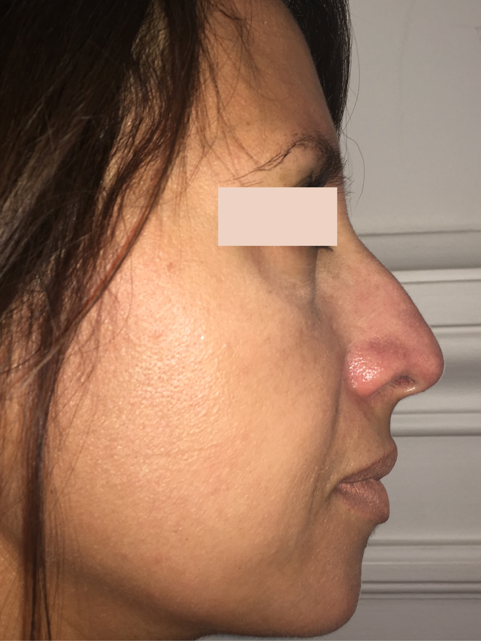 Rhinoplastie chirurgicale avant