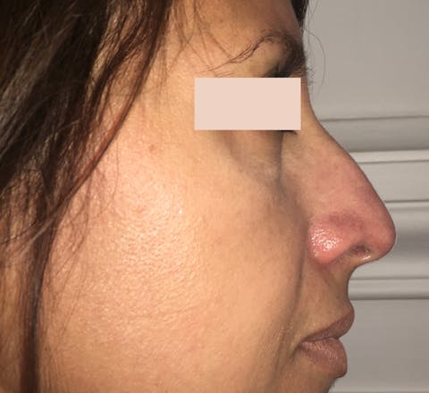 Rhinoplastie chirurgicale avant