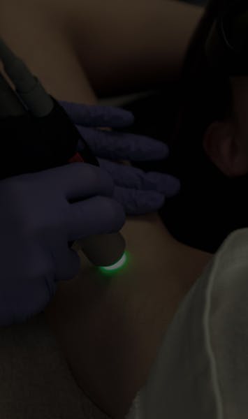 Epilation laser par le Dr. Alexandre Mertens