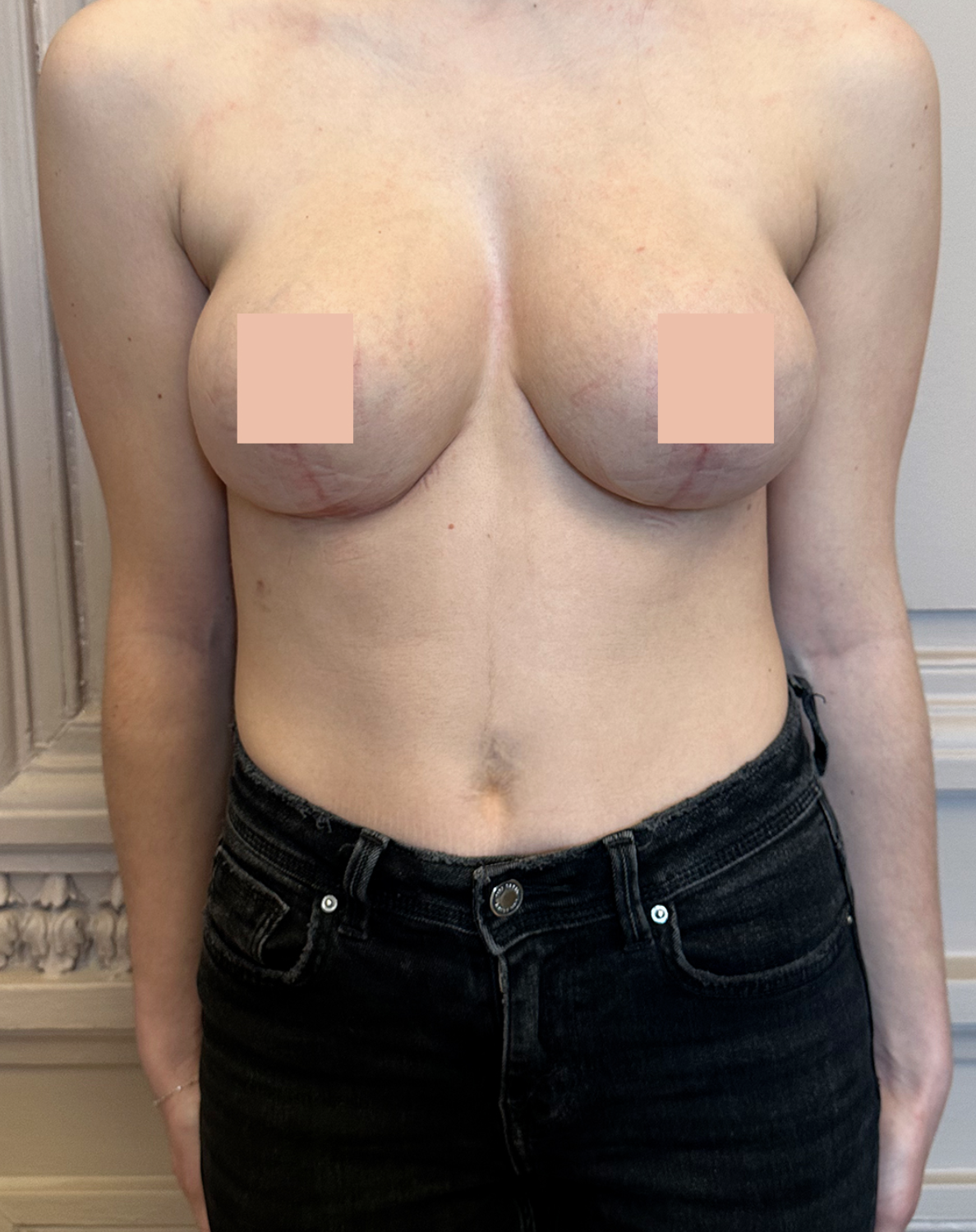 La réduction mammaire après