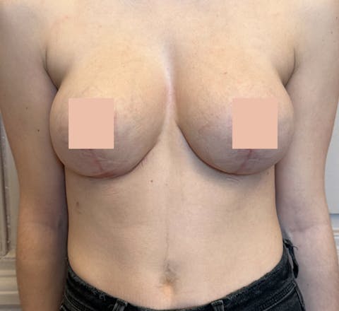 La réduction mammaire après