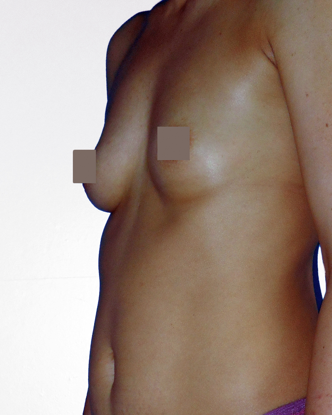 Lipofilling mammaire avant