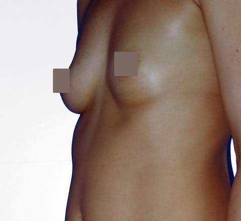 Lipofilling mammaire avant