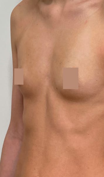 Augmentation mammaire par implants avant