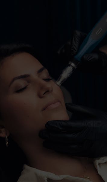 Radiofréquence microneedling par le Dr Mertens
