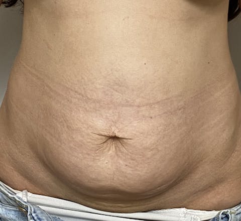 Avant Plastie abdominale – Abdominoplastie