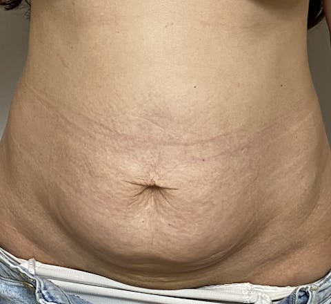 Avant mini lift du ventre