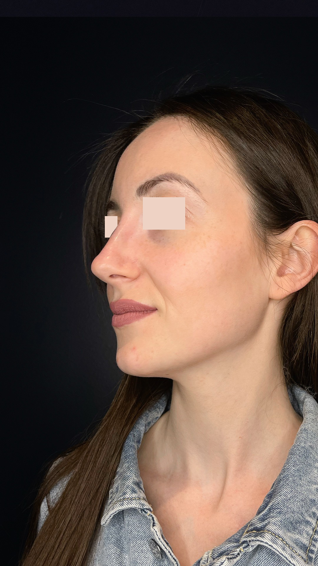 Rhinoplastie médicale après