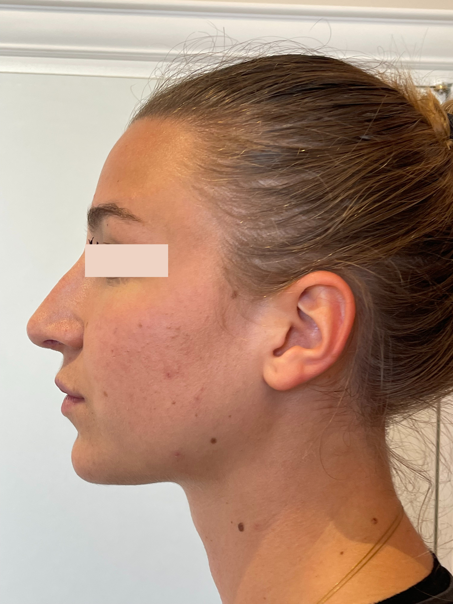 Aprés Rhinoplastie primaire