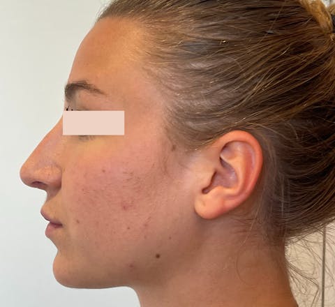Aprés Rhinoplastie primaire