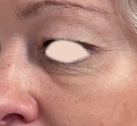 Blépharoplastie avant