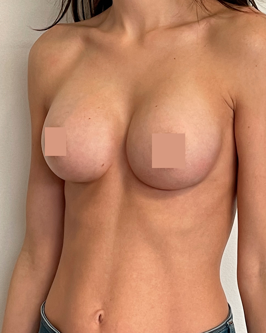 L’augmentation mammaire par prothèses après