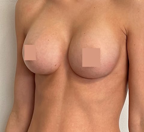 L’augmentation mammaire par prothèses après