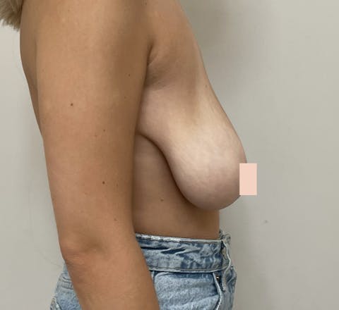 Lifting mammaire avant