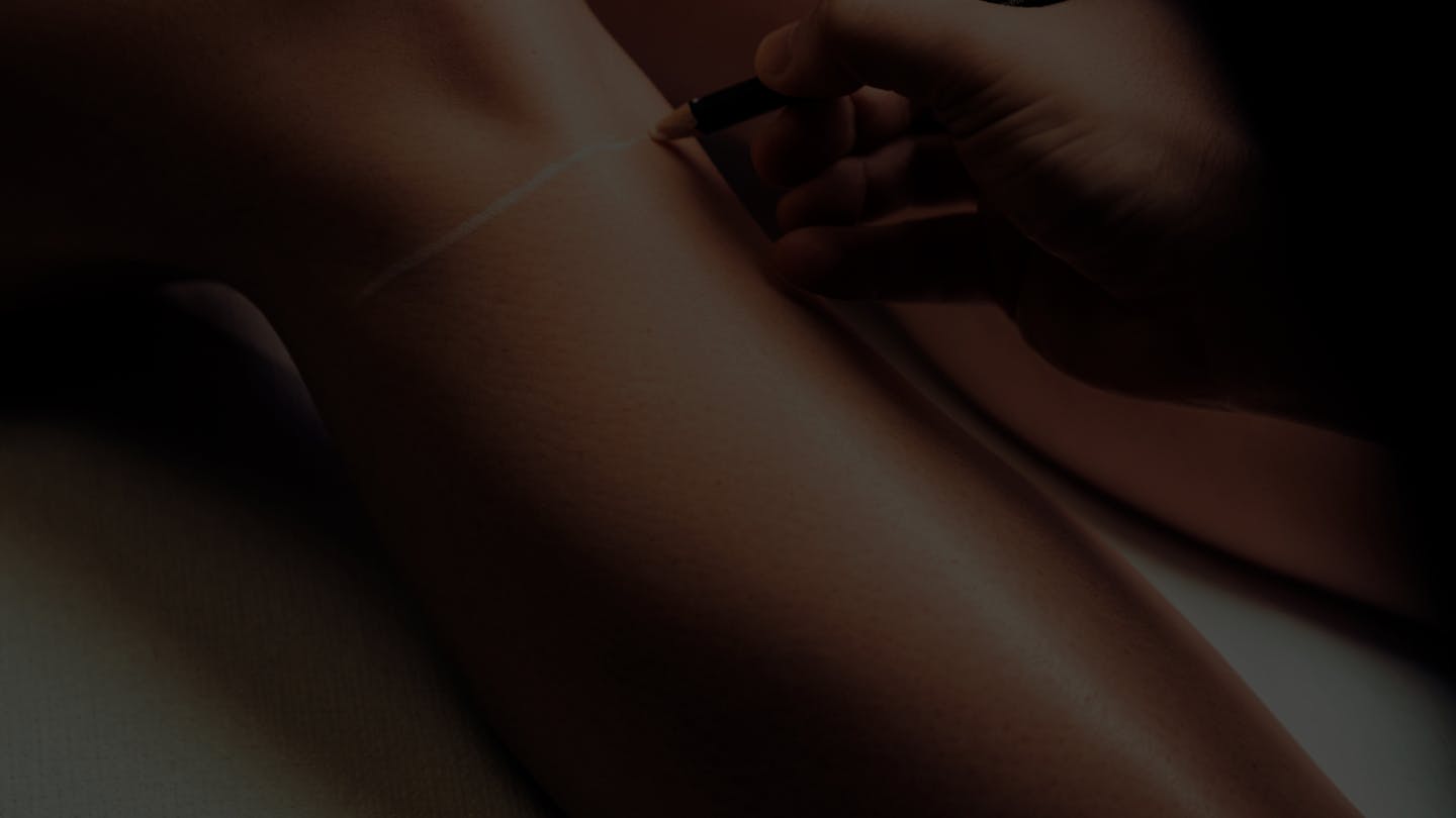 Consultation & Stratégie Epilation laser toutes peaux à Lyon ou Vienne
