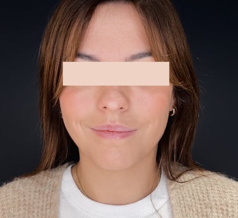 Avant Injections d’acide hyaluronique dans les lèvres