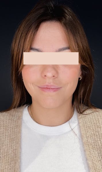 Injections d'acide hyaluronique avant