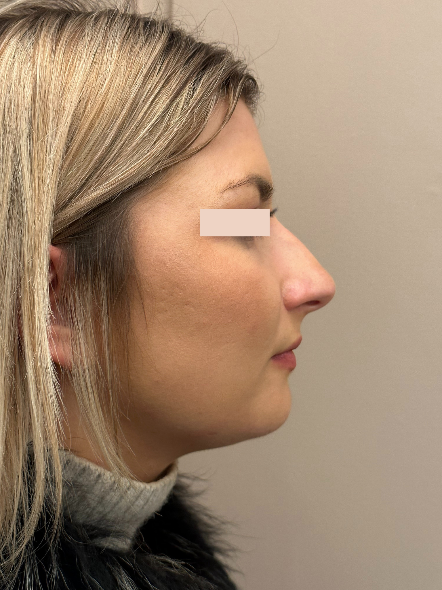 Avant Rhinoplastie primaire