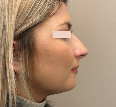 Avant Rhinoplastie primaire