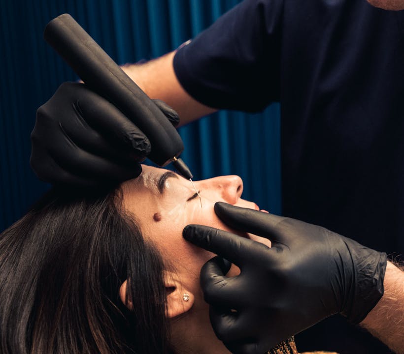 Les fils tenseurs par le Dr. Alexandre Mertens à Lyon Vienne