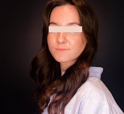 Avant Injections d’acide hyaluronique dans les lèvres