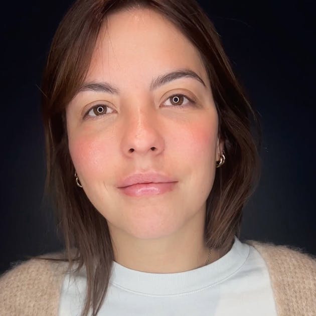 Injections d’acide hyaluronique : des lèvres et une bouche sublimées par le Dr. Alexandre Mertens à Lyon Vienne