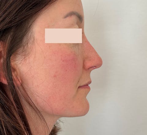Aprés Rhinoplastie primaire