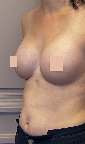 Augmentation mammaire par prothèses après