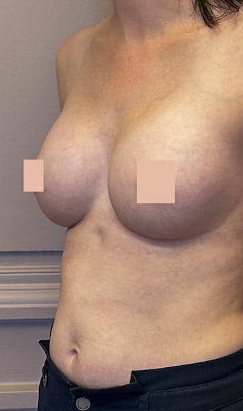 Pose de prothèses mammaires après