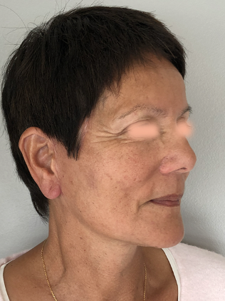 Lifting facial après