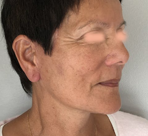 Lifting facial après