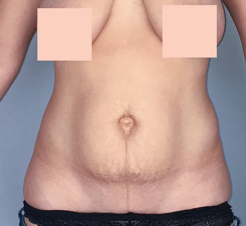 Abdominoplastie et lifting avant
