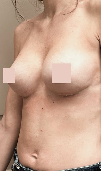 Augmentation mammaire par lipofilling après