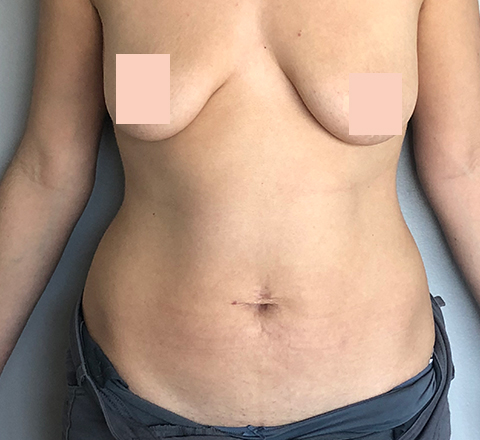 Abdominoplastie avant