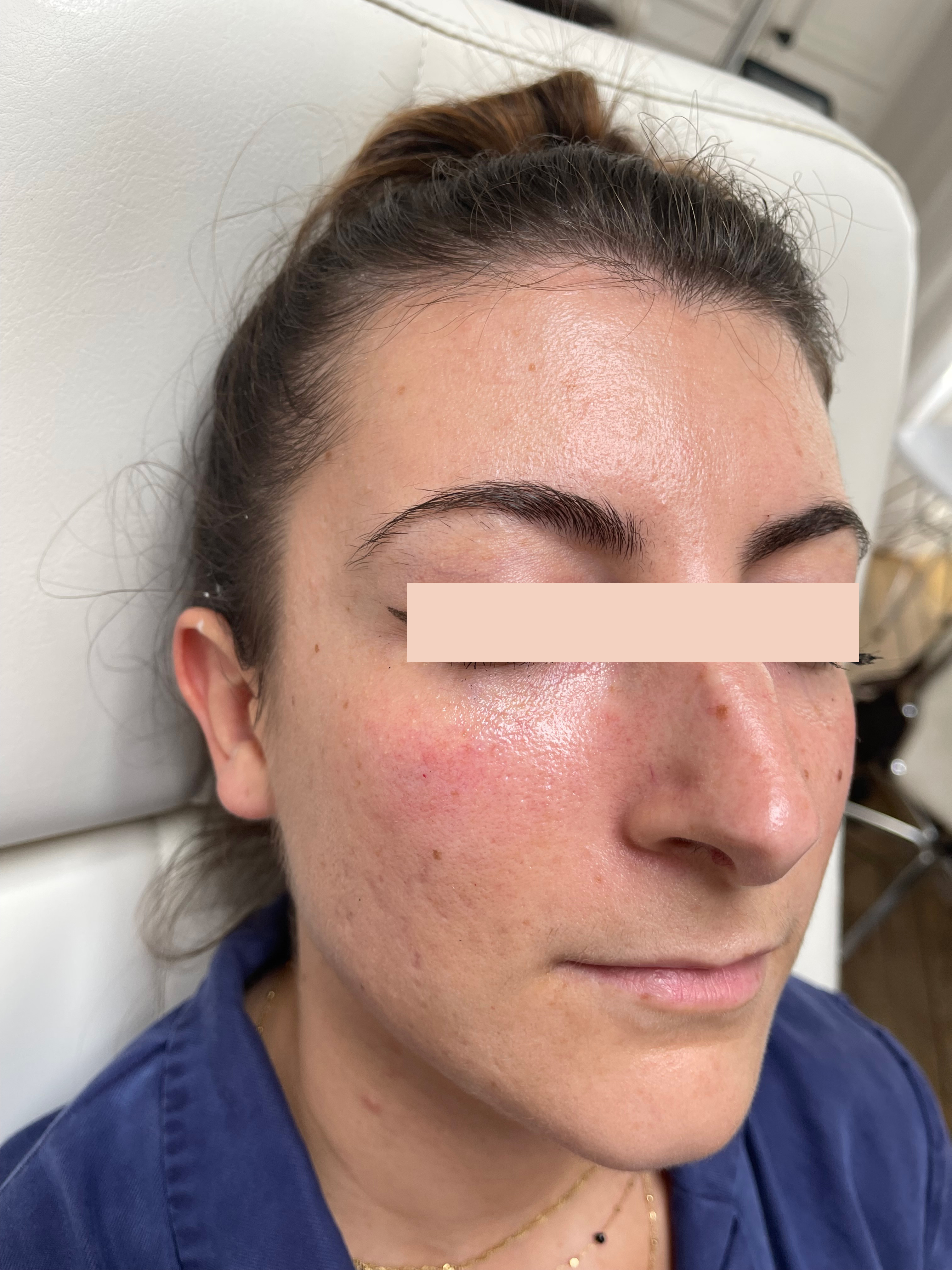 Avprès Acide hyaluronique dans les cernes