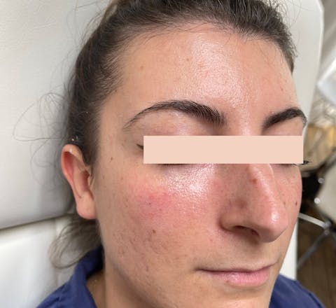 Avprès Acide hyaluronique dans les cernes